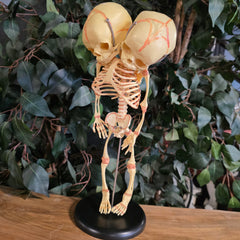 Two-Headed Human Fetal Skeleton (CAST)