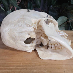 Human Skull, Medical F (Underbite)