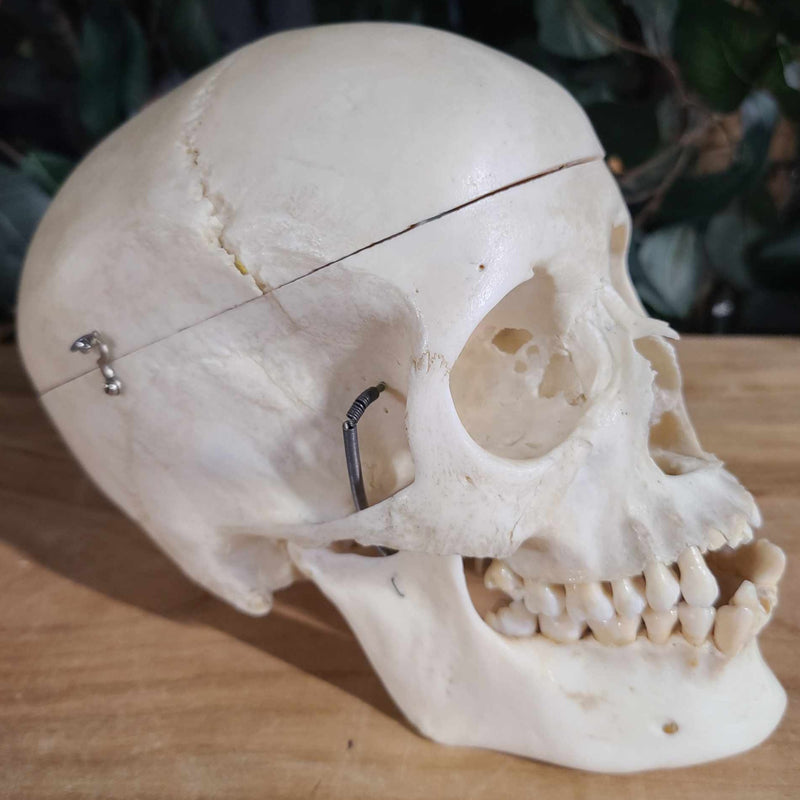 Human Skull, Medical F (Underbite)