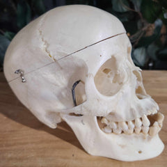 Human Skull, Medical F (Underbite)