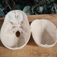 Human Skull, Medical F (Underbite)