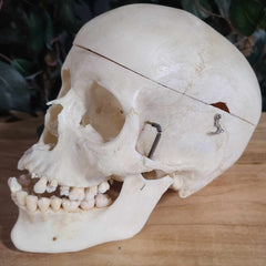 Human Skull, Medical F (Underbite)