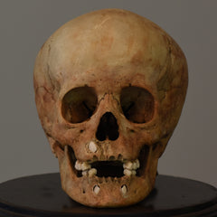 Human Child Skull, Hydrocephalic