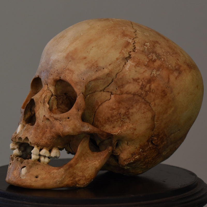 Human Child Skull, Hydrocephalic