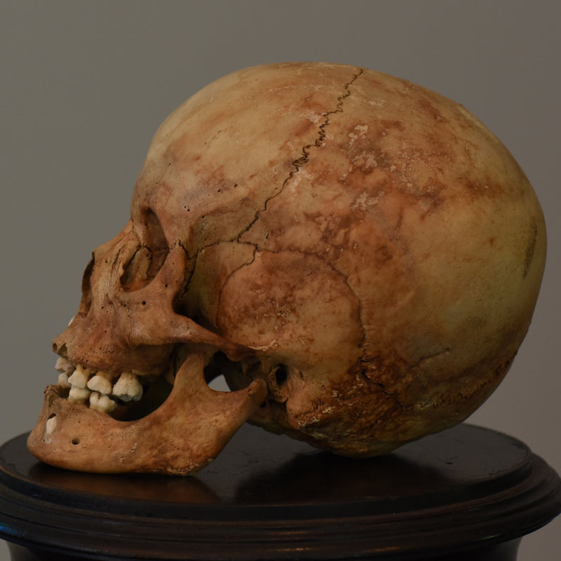 Human Child Skull, Hydrocephalic