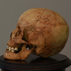 Human Child Skull, Hydrocephalic