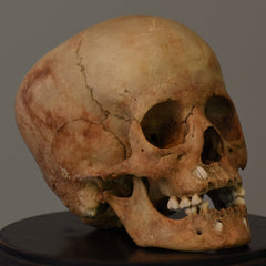 Human Child Skull, Hydrocephalic