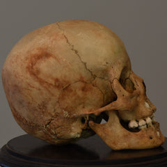 Human Child Skull, Hydrocephalic