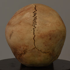 Human Child Skull, Hydrocephalic