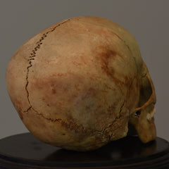 Human Child Skull, Hydrocephalic