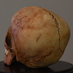 Human Child Skull, Hydrocephalic