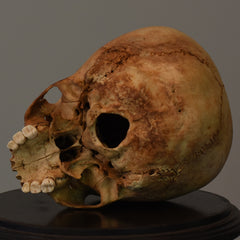 Human Child Skull, Hydrocephalic