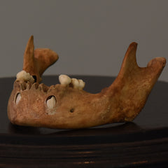 Human Child Skull, Hydrocephalic