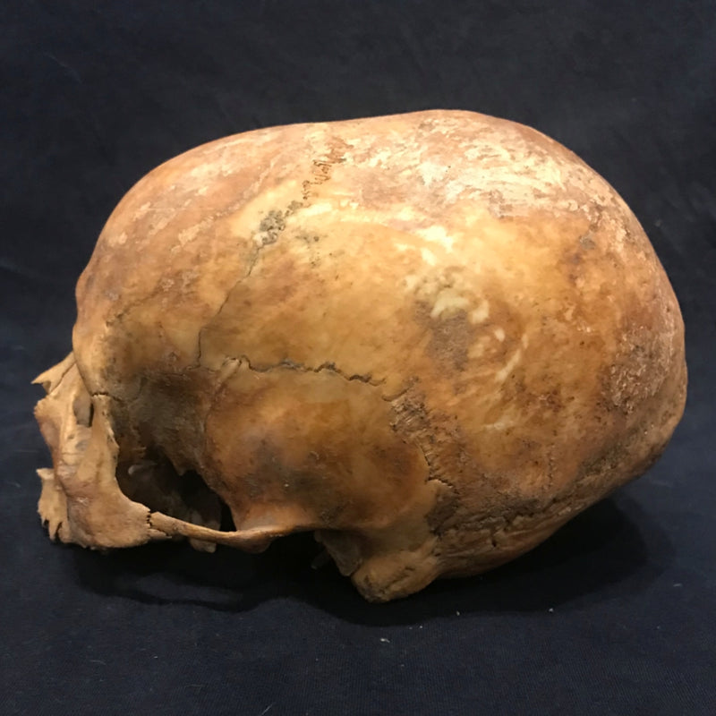 Toulouse Elongated Skull, Medieval